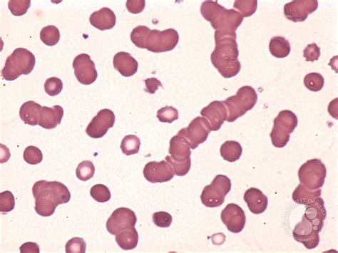 roulette formation in blood cells.